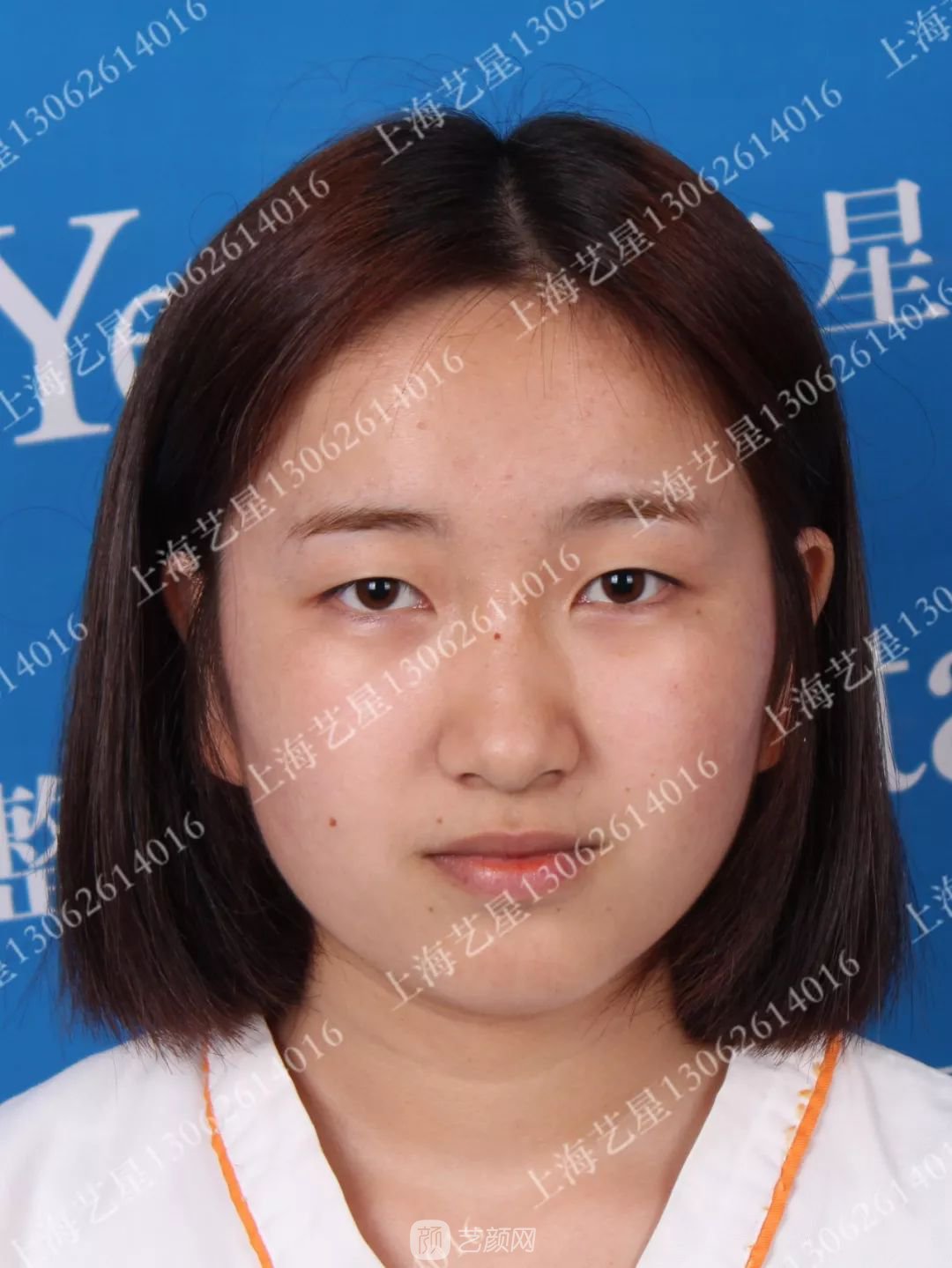 上海藝星割雙眼皮術后一個月恢復日記一則~