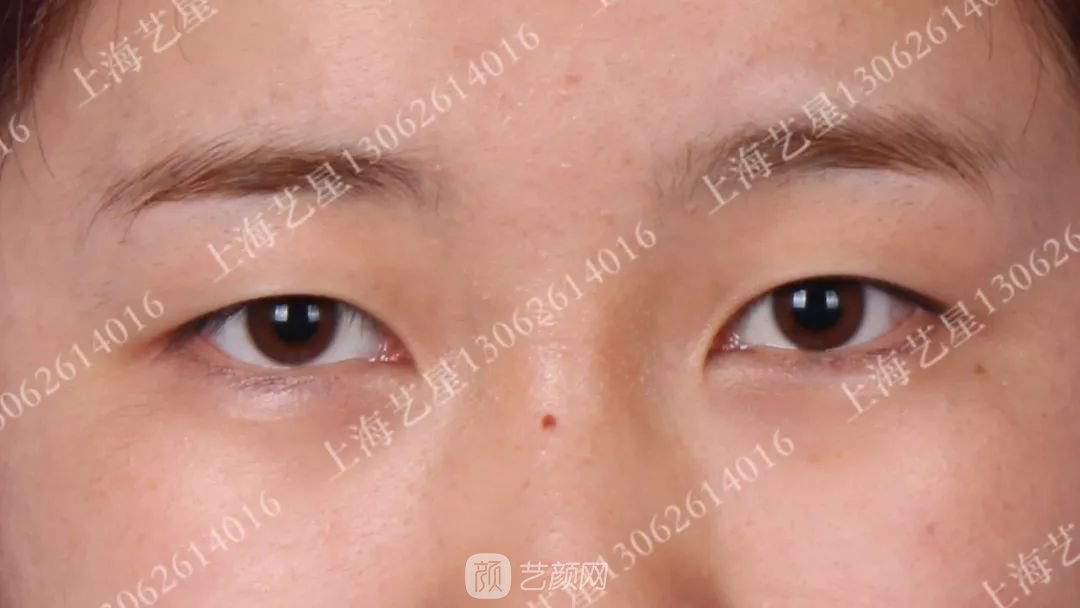 上海藝星割雙眼皮術后一個月恢復日記一則~