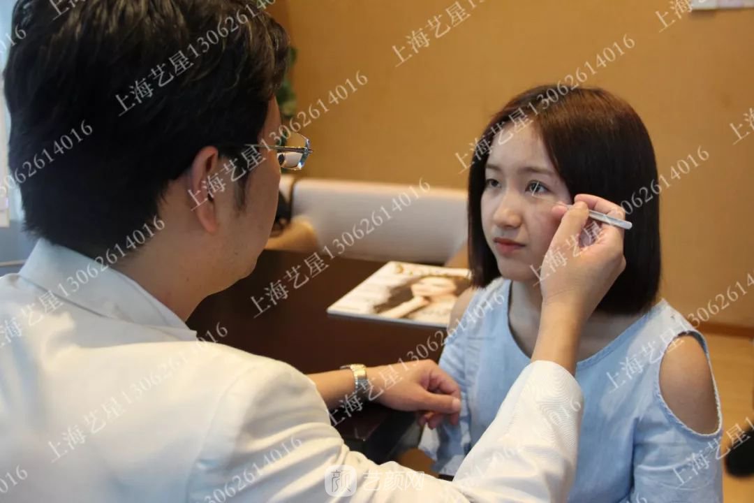 上海藝星割雙眼皮術后一個月恢復日記一則~