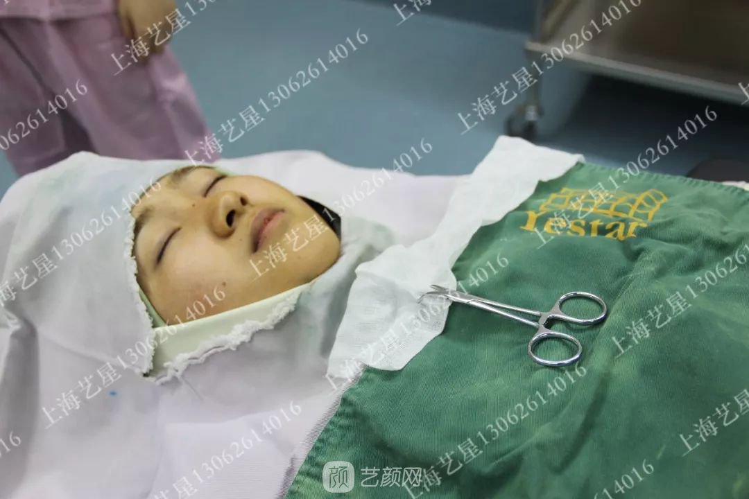 上海藝星割雙眼皮術后一個月恢復日記一則~