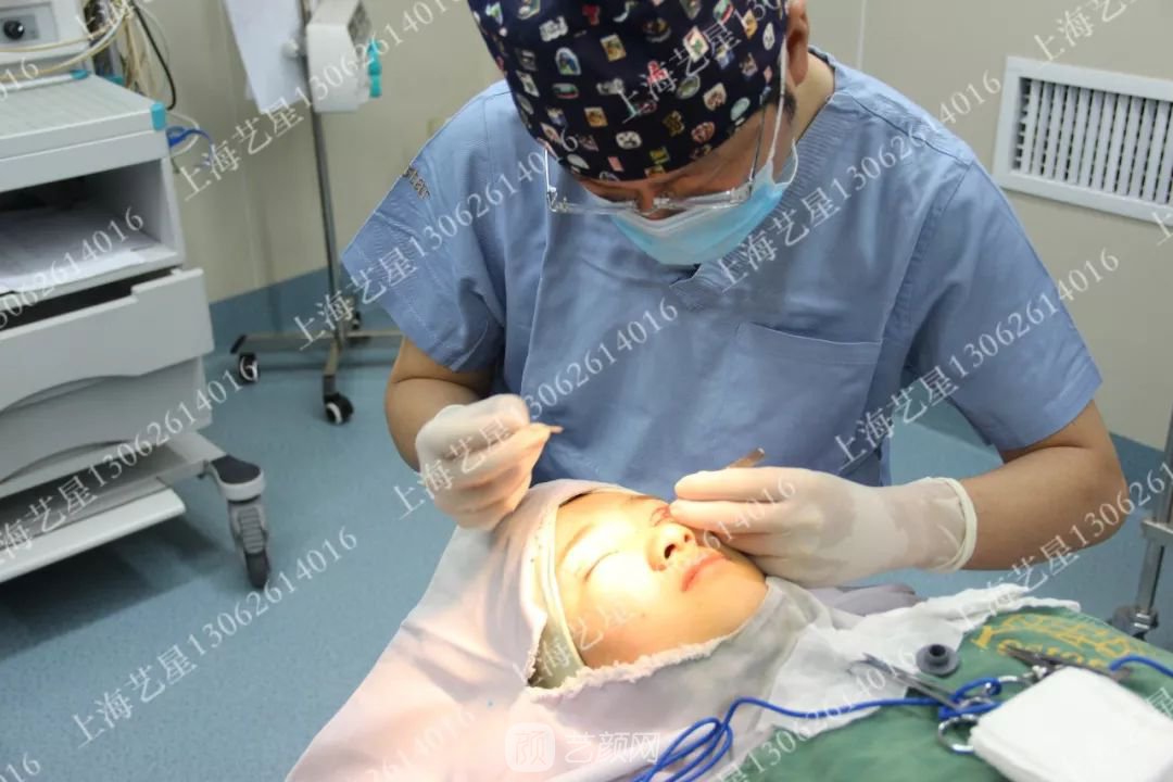 上海藝星割雙眼皮術后一個月恢復日記一則~