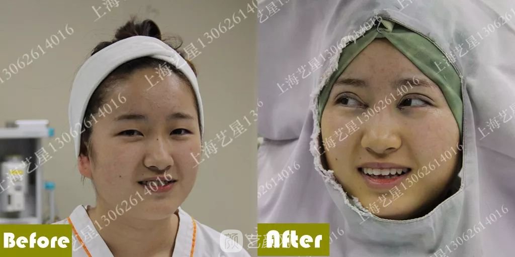 上海藝星割雙眼皮術后一個月恢復日記一則~