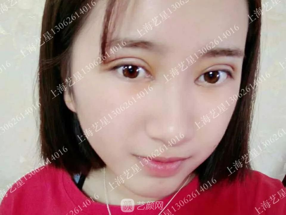 上海藝星割雙眼皮術后一個月恢復日記一則~