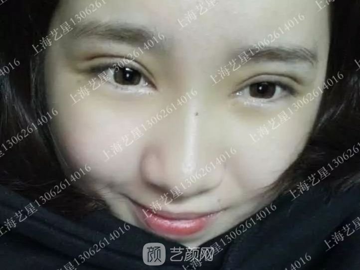 上海藝星割雙眼皮術后一個月恢復日記一則~
