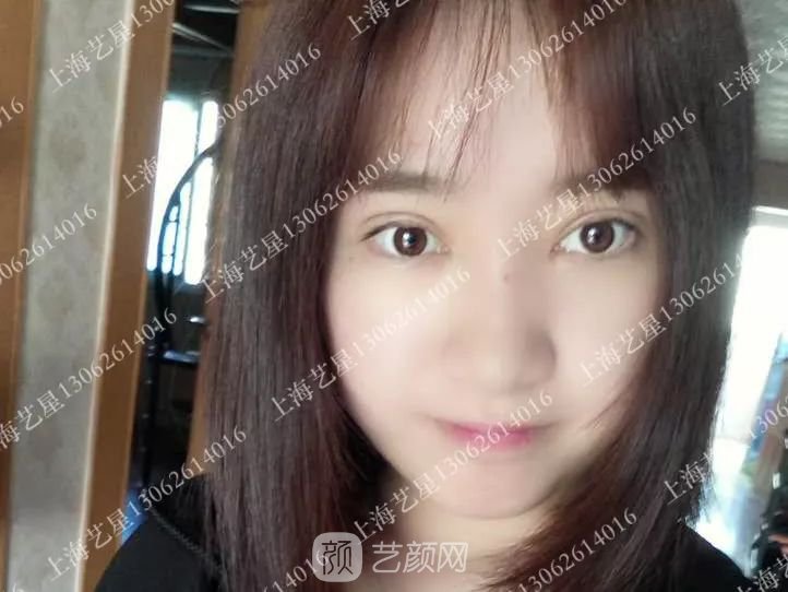 上海藝星割雙眼皮術后一個月恢復日記一則~