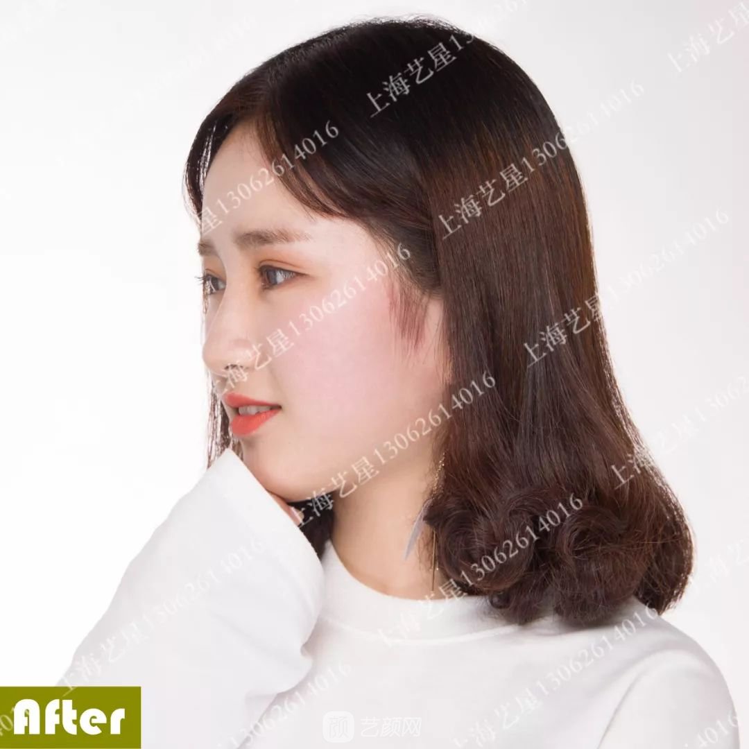 上海藝星割雙眼皮術后一個月恢復日記一則~