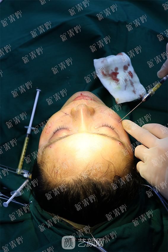 杭州新清吟陳永自體脂肪面部填充+注射瘦臉除皺案例直播~