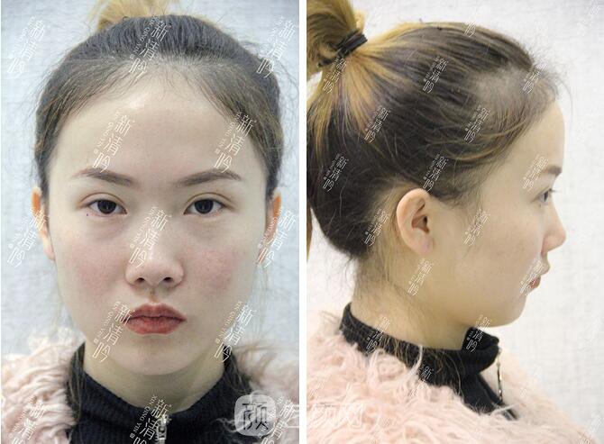 耳軟骨隆鼻果圖分享，術(shù)后~