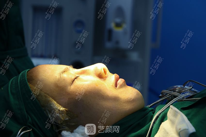 耳軟骨隆鼻果圖分享，術(shù)后~