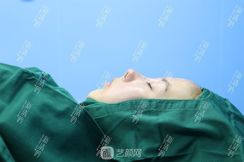 耳軟骨隆鼻果圖分享，術(shù)后~