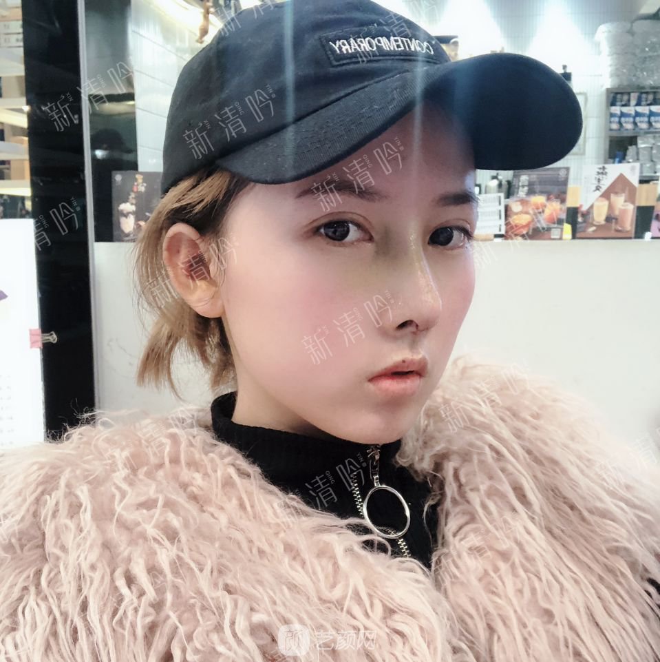 耳軟骨綜合隆鼻半個月了，分享恢復果照片~