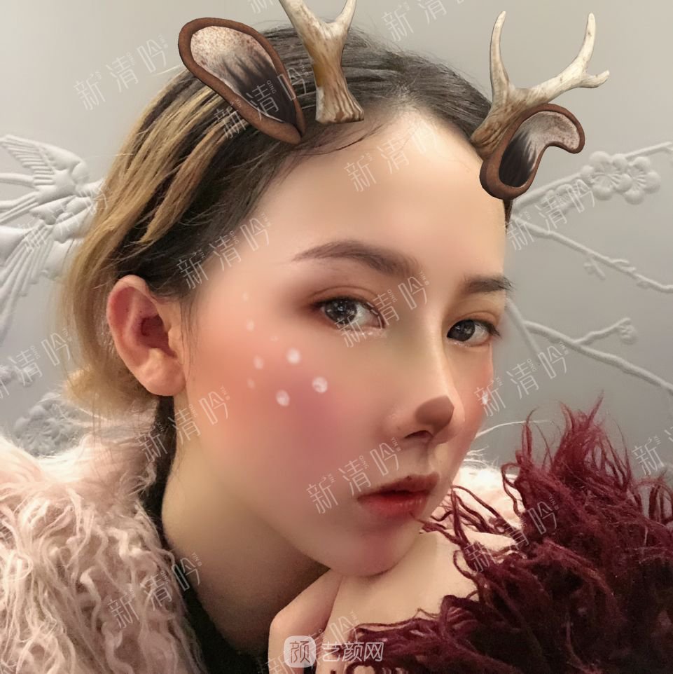 耳軟骨綜合隆鼻半個月了，分享恢復果照片~