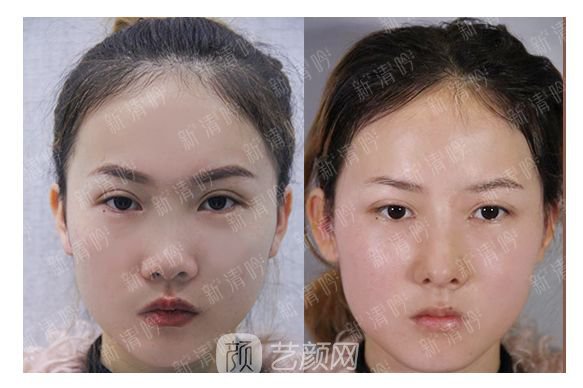 耳軟骨綜合隆鼻半個月了，分享恢復果照片~