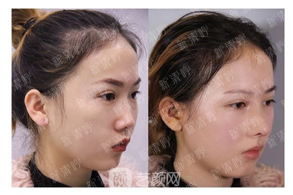 耳軟骨綜合隆鼻半個月了，分享恢復果照片~