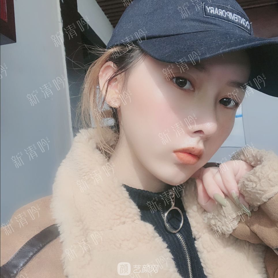 耳軟骨綜合隆鼻半個月了，分享恢復果照片~