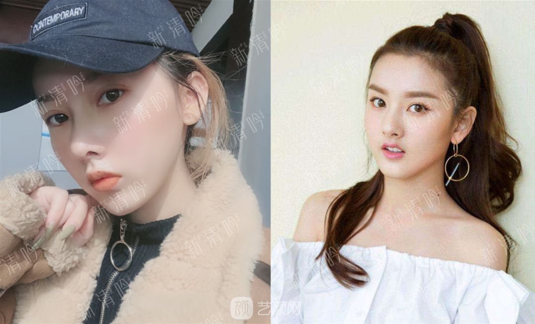 耳軟骨綜合隆鼻半個月了，分享恢復果照片~