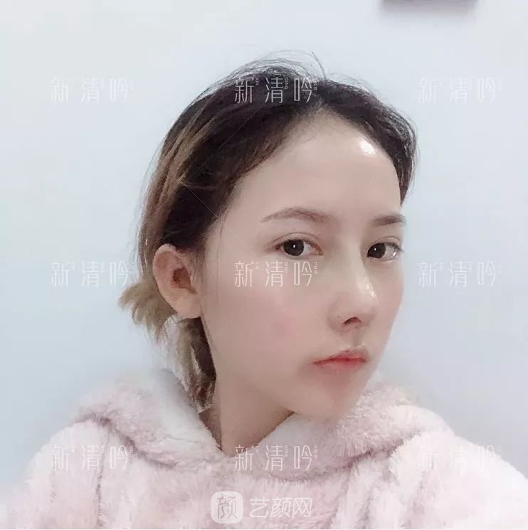 耳軟骨隆鼻果怎么樣？案例照片一覽~