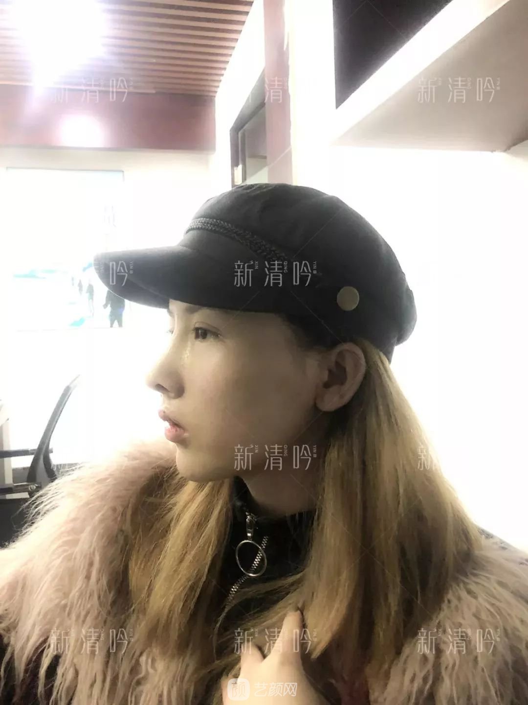 耳軟骨隆鼻果怎么樣？案例照片一覽~