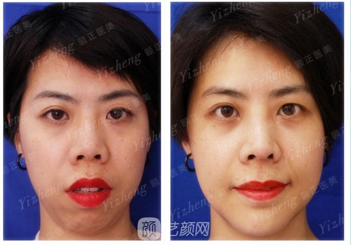 自體肋軟骨隆鼻+假體隆下頜一個(gè)月果照片分享~