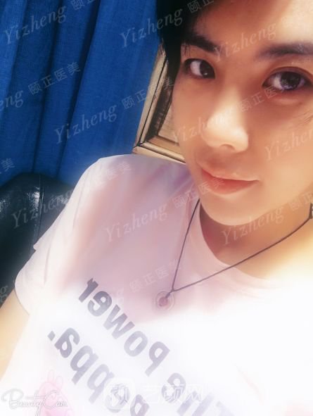 自體肋軟骨隆鼻+假體隆下頜一個(gè)月果照片分享~