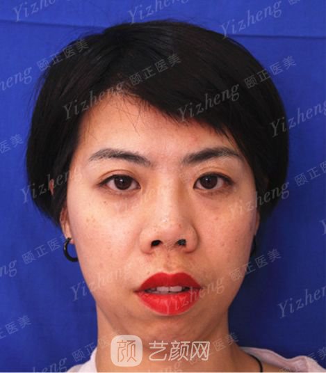 自體肋軟骨隆鼻+假體隆下頜一個(gè)月果照片分享~