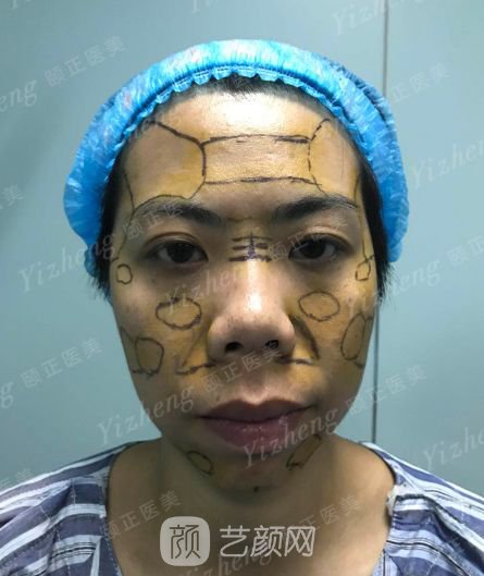 自體肋軟骨隆鼻+假體隆下頜一個(gè)月果照片分享~