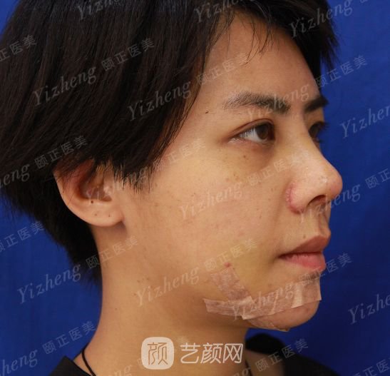 自體肋軟骨隆鼻+假體隆下頜一個(gè)月果照片分享~