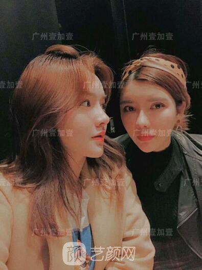 廣州壹加壹假體隆鼻修復(fù)圖