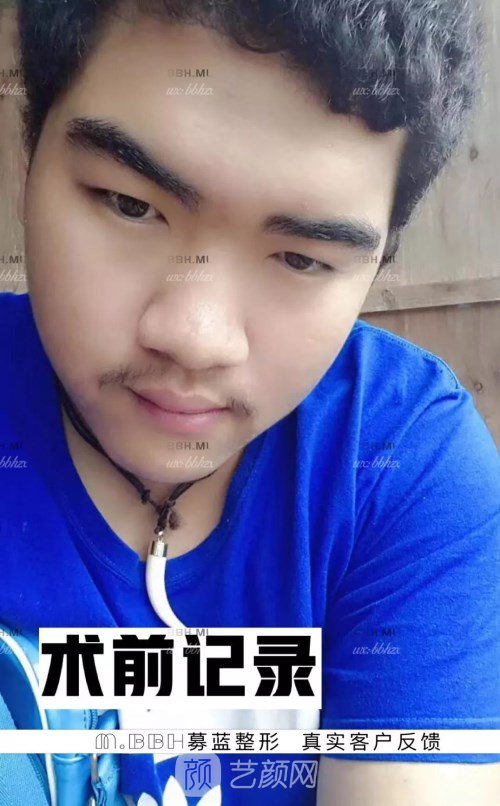 眼部手術(shù)案例——昆明募藍(lán)術(shù)后一年果照片分享~