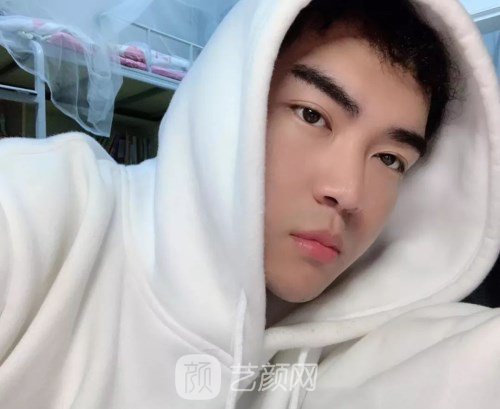 眼部手術(shù)案例——昆明募藍(lán)術(shù)后一年果照片分享~