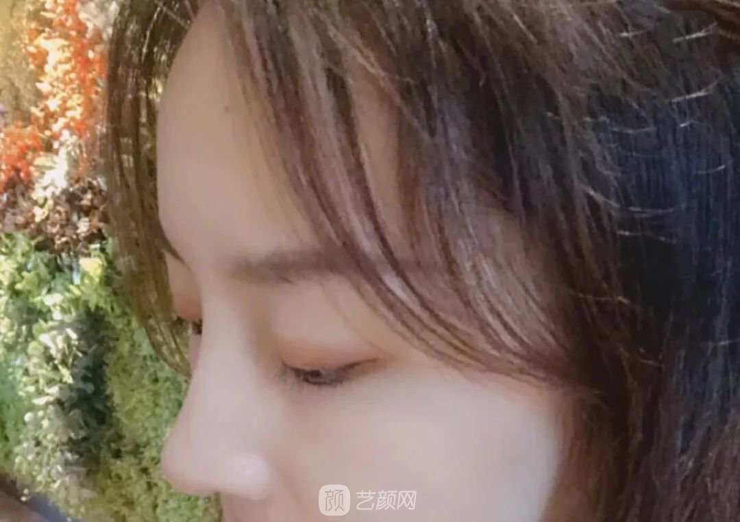 鼻部手術(shù)一個月恢復(fù)日記分享~