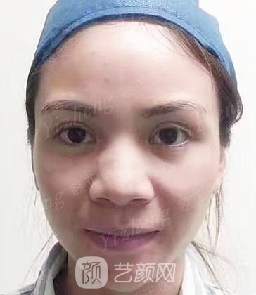葫蘆島頤正夏秉成鼻部手術(shù)+SVF自體脂肪多方面部填充案例~