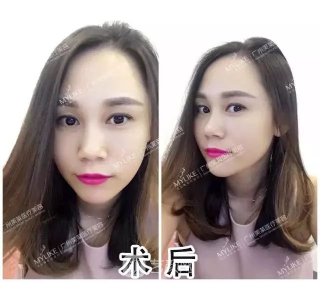 廣州美萊玻尿酸全臉填充果照片分享~