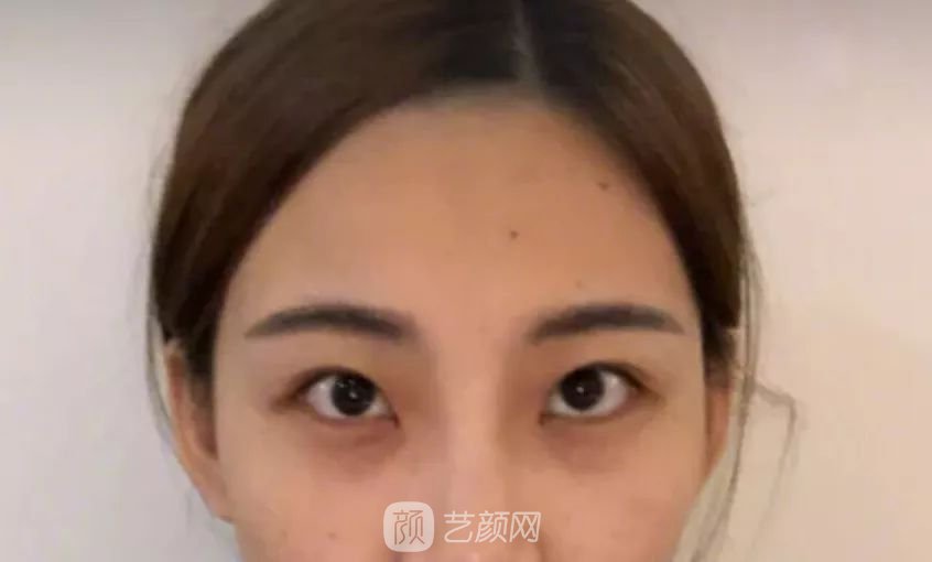 眼部手術(shù)一個(gè)月恢復(fù)日記，片分享~