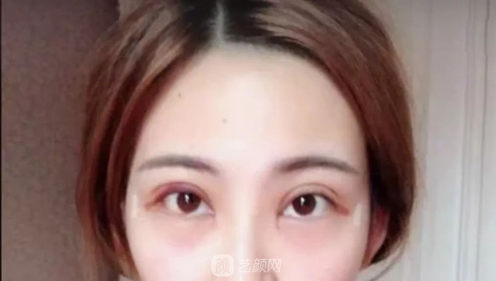 眼部手術(shù)一個(gè)月恢復(fù)日記，片分享~