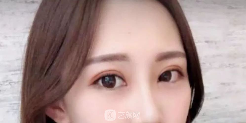 眼部手術(shù)一個(gè)月恢復(fù)日記，片分享~