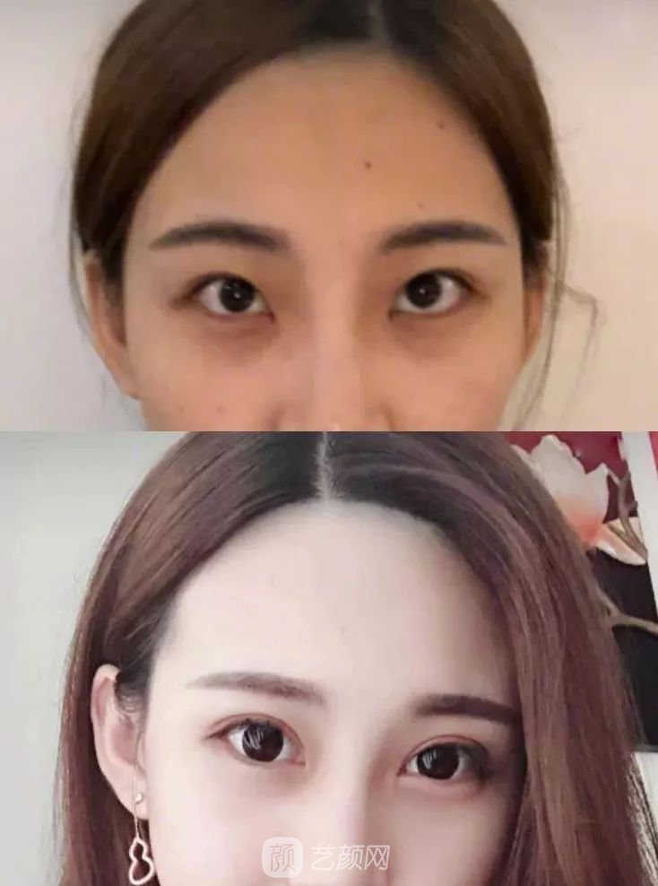 眼部手術(shù)一個(gè)月恢復(fù)日記，片分享~