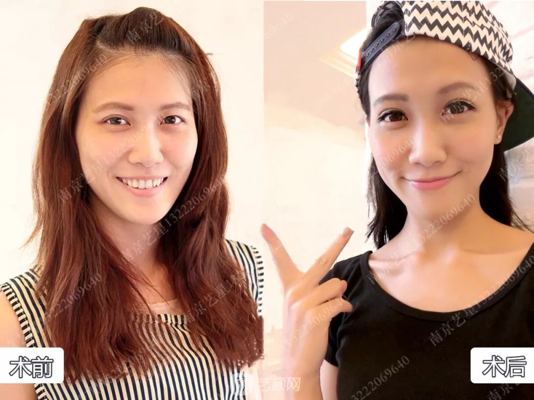 Yestar美杜莎美眼術(shù)一周案例圖片，芭比雙眼皮果很好~