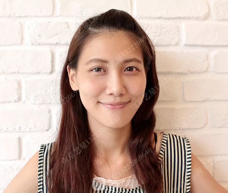 Yestar美杜莎美眼術(shù)一周案例圖片，芭比雙眼皮果很好~