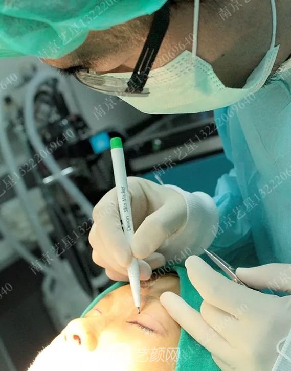 Yestar美杜莎美眼術(shù)一周案例圖片，芭比雙眼皮果很好~