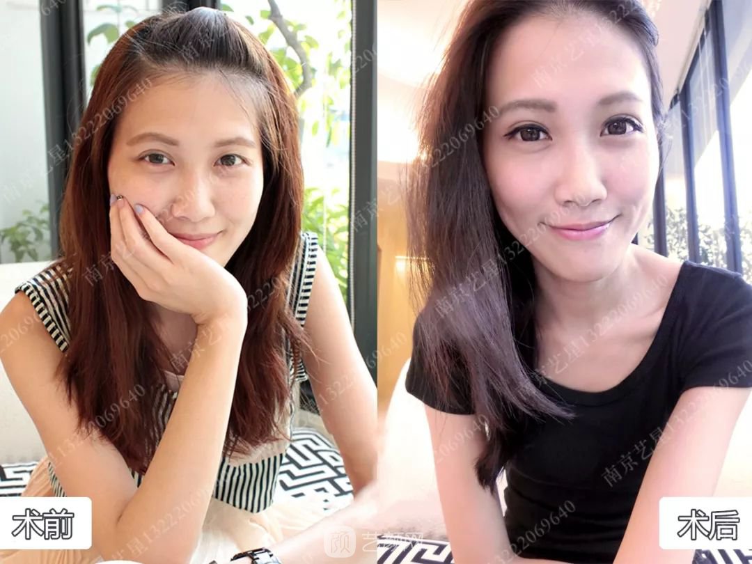 Yestar美杜莎美眼術(shù)一周案例圖片，芭比雙眼皮果很好~