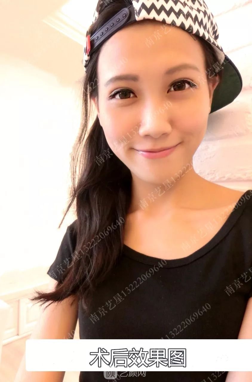 Yestar美杜莎美眼術(shù)一周案例圖片，芭比雙眼皮果很好~