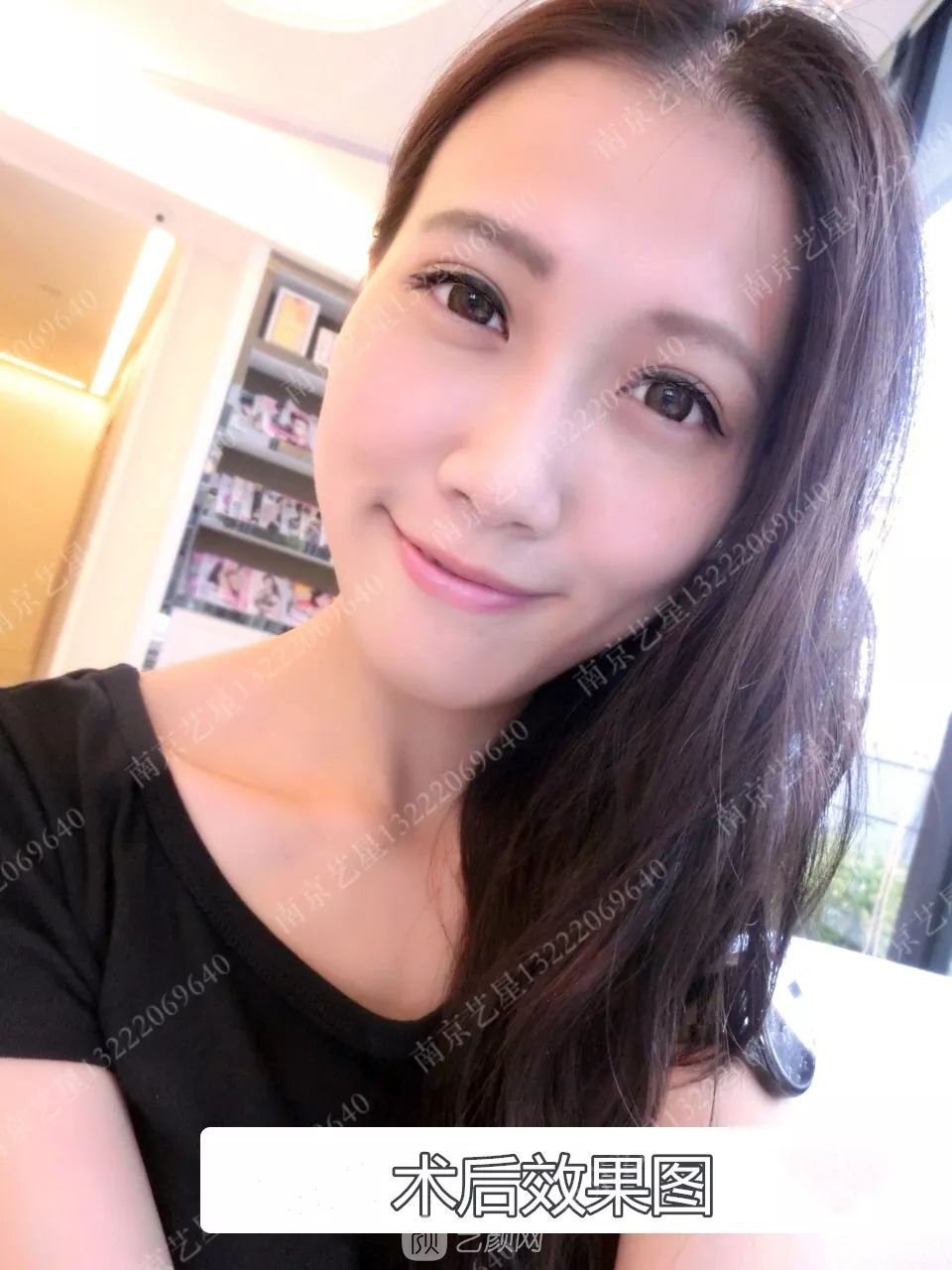 Yestar美杜莎美眼術(shù)一周案例圖片，芭比雙眼皮果很好~