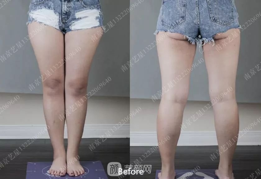 南京藝星自體脂肪豐胸術(shù)一個(gè)月案例分享~