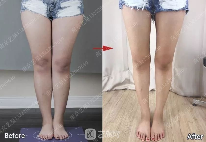 南京藝星自體脂肪豐胸術(shù)一個(gè)月案例分享~