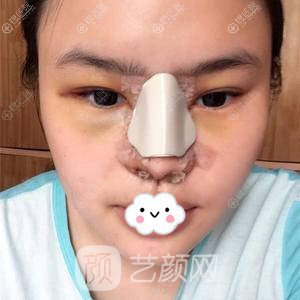 成都美容整形醫(yī)院硅膠隆鼻+假體墊下巴術(shù)后果圖