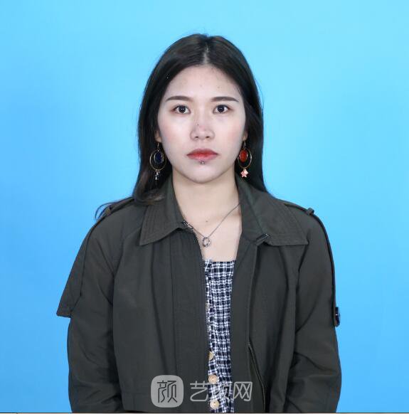 開眼角圖真實(shí)案例分享哦