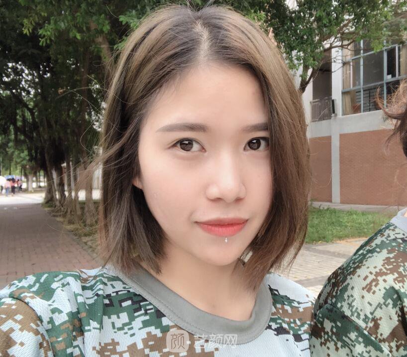 開眼角圖真實(shí)案例分享哦