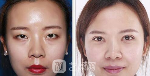 王建宇醫(yī)生眼部整形案例