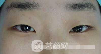 張嬌嬌醫(yī)生做的小切口雙眼皮手術(shù)案例